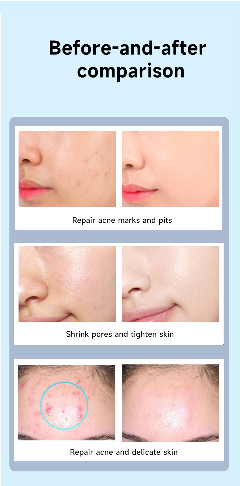 Best Microneedling Machine 16pin Wireless Pen Derma Roller For Face Rejuvenation Beauty Products 